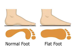 How to Cure Flat Feet