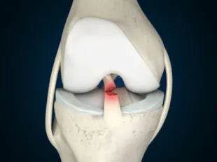 ACL Ligament Tear: Understanding the Injury and Its Impact on Mobility