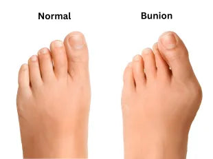 Hallux Valgus: Understanding the Condition and How to Manage It