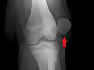 Patella Dislocation: Causes, Symptoms, and Recovery Tips
