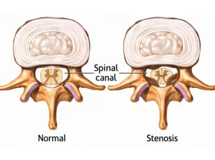 Spinal Stenosis: What You Need to Know