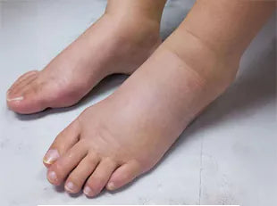 How to Treat Edema and Reduce Swelling